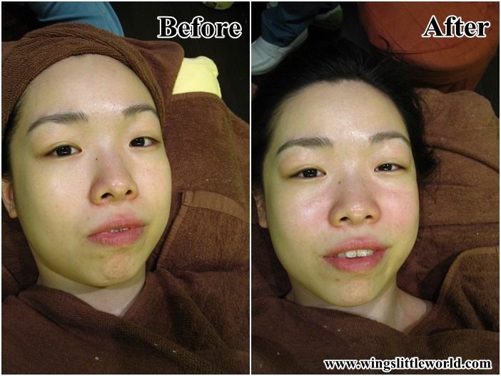 livenwell-nose-treatment-9