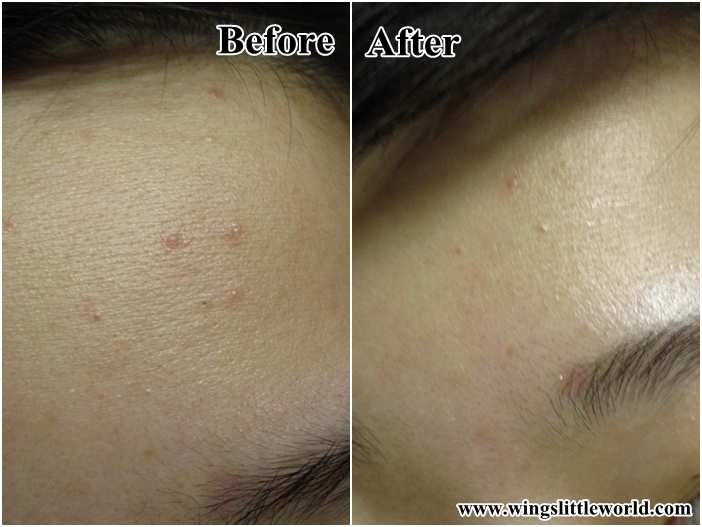 metholatum-acnes-scar-care-jell-6