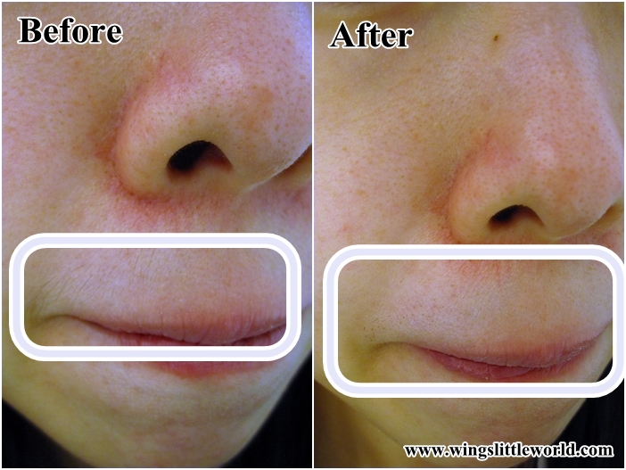 medilase-upperlips-8