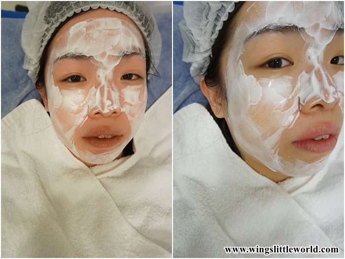 faceit-restylane-treatment-2