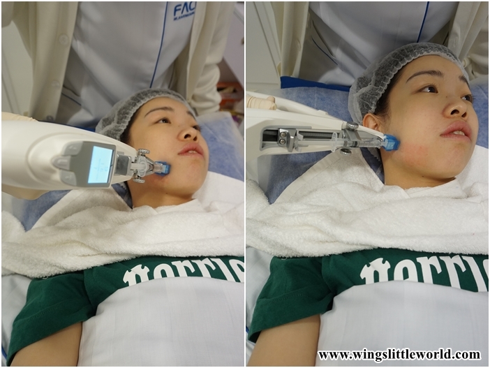 faceit-restylane-treatment-3