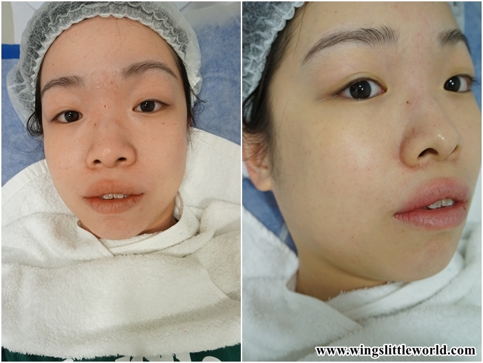 faceit-restylane-treatment-4