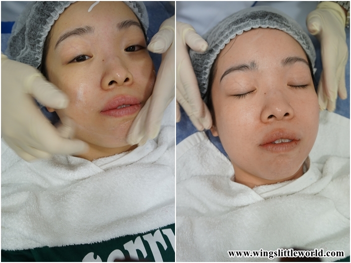 faceit-restylane-treatment-5