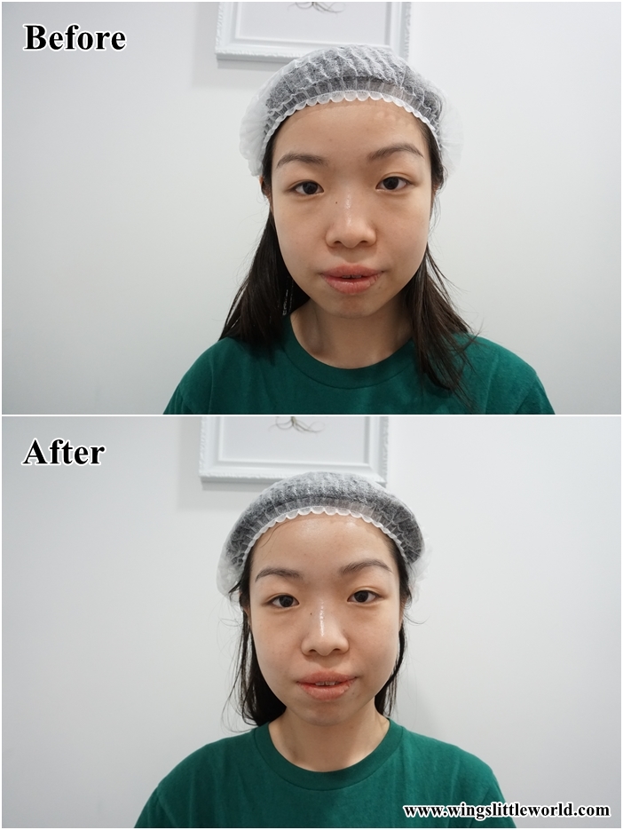 faceit-restylane-treatment-6