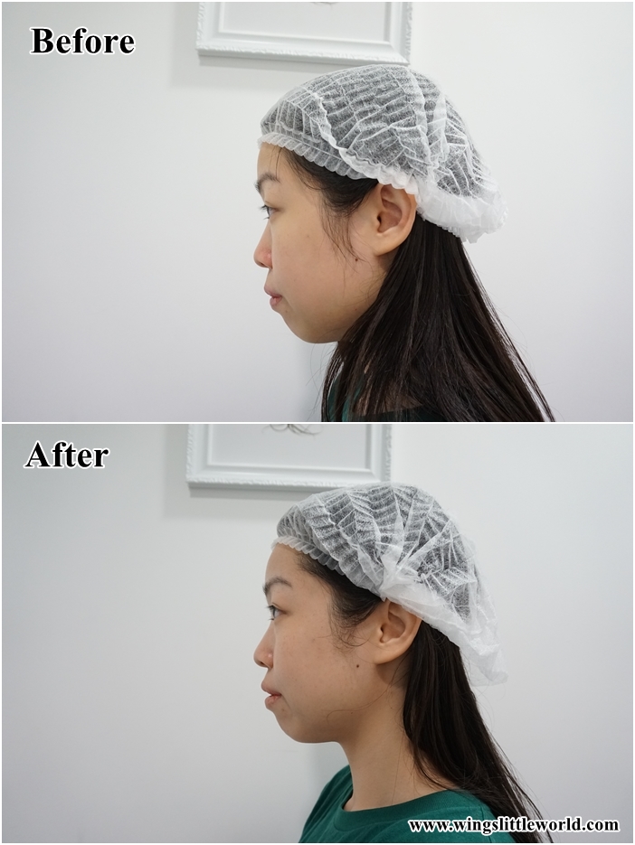 faceit-restylane-treatment-7