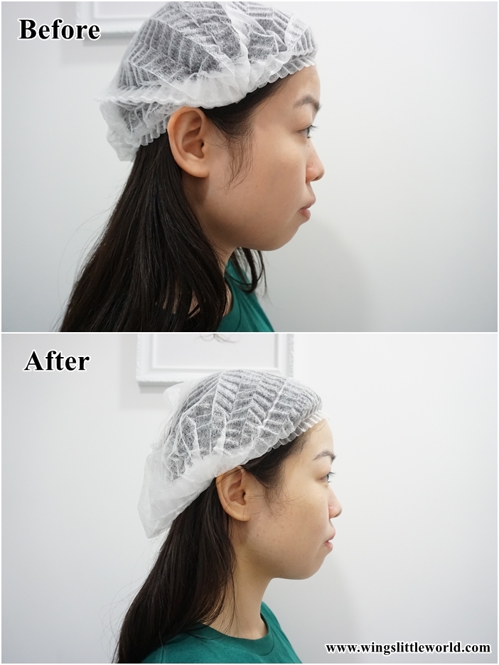 faceit-restylane-treatment-8