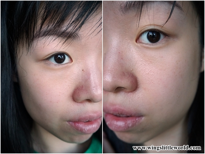 faceit-restylane-treatment-9