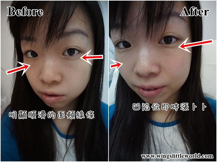 mioggi-juvederm-6-edited