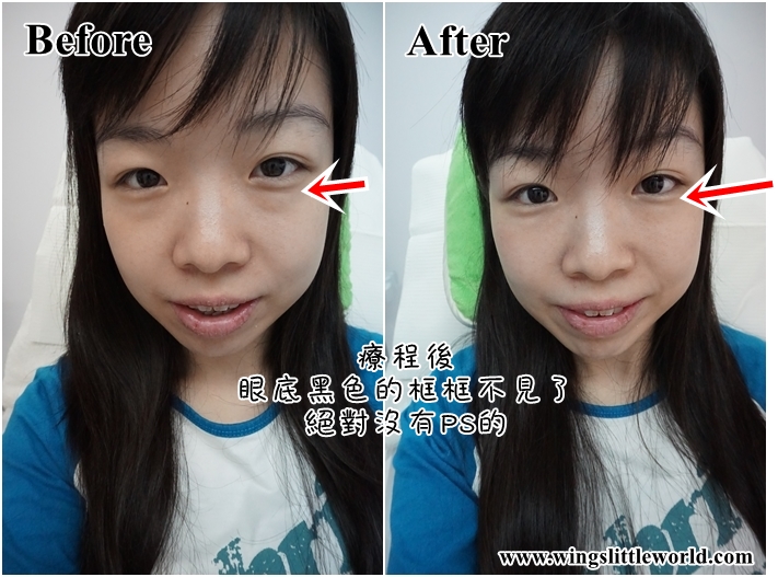 mioggi-juvederm-7-edited