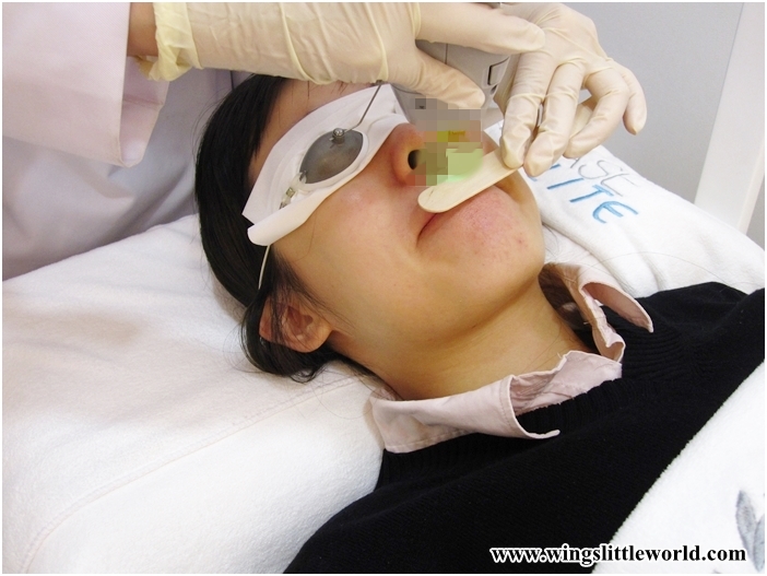 medilase-upperlips-7