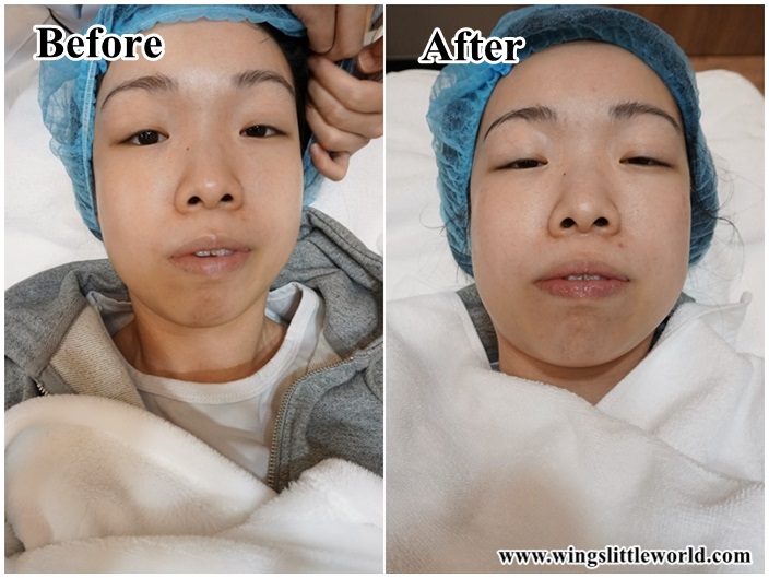 aesmedic-picolaser-15-edited